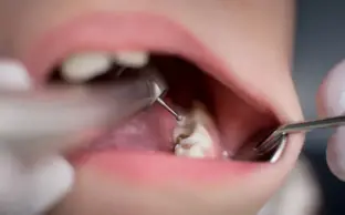 علائم به عصب رسیدن دندان چیست؟