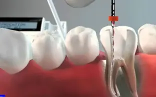 طول عمر دندان عصب کشی شده چقدر است؟