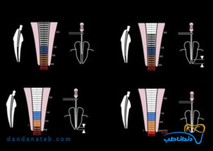 اپکس لوکیتور Woodpecker - Woodpex X
