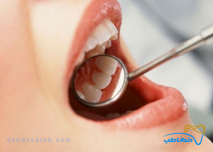 آینه دندانپزشکی