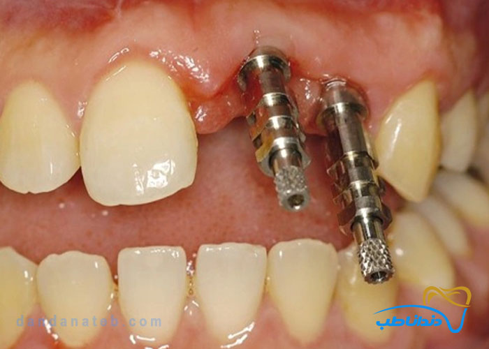 ایمپرشن کوپینگ در دندانپزشکی