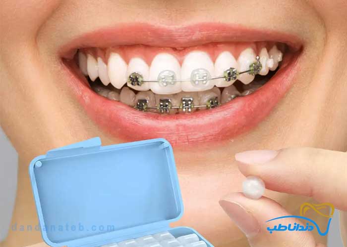 انواع موم دندانپزشکی