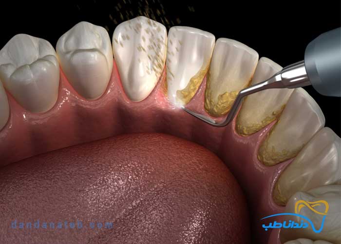 وسایل جرم گیری دندان؛ معرفی ابزارها و تجهیزات جرم گیری دندانپزشکی