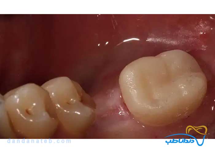 اندو کراون چیست؟