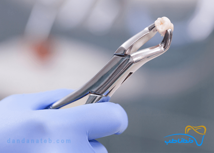 انواع پنس دندانپزشکی