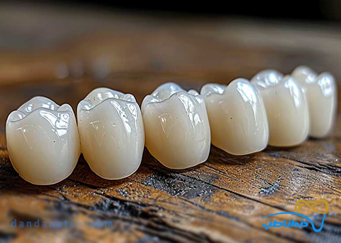 مراحل قالب گیری دندان برای روکش