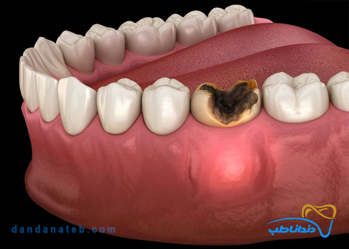 راهنمای جامع درمان عفونت دندان برای دندانپزشکان؛ مواد و روش‌های درمان