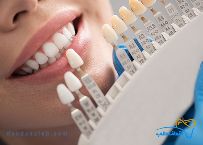 شید گاید دندانپزشکی چیست؟ راهنمای انتخاب رنگ طبیعی